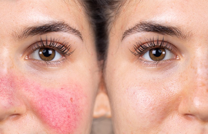 Come alleviare il rossore (rosacea)?